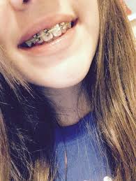 You can make fake braces and a fake retainer using bobby pins, wax, and earring. How To Make Fake Braces Take A Rainbow Loom Rubber Band And Take 4 Earring Backs And Put The How To Make Fake Braces Fake Braces Rainbow Loom Rubber Bands