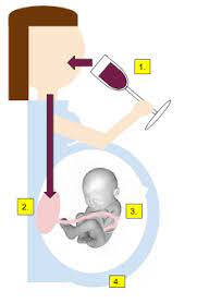 Fetal Alcohol Spectrum Disorder Wikipedia
