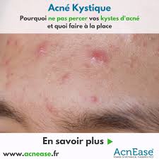 Un kyste fibreux qui se forme à partir d'un canal thyroglosse persistant. Pourquoi Ne Pas Percer Vos Kystes D Acne Et Ce Qu Il Faut Faire A La Place Acnease