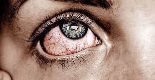 Manchas De Sangre O Venas En El Ojo