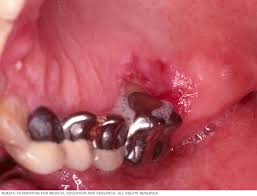 Image result for gums cancer symptoms