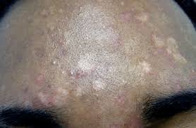 En égypte, où, vers 2600 av. Pityriasis 6 Solutions Naturelles Contre Ces Taches Blanches Sur La Peau