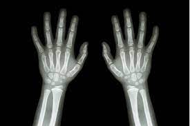What Is A Growth Plate Or Epiphyseal Plate? – Bonescience