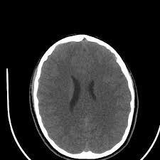 Librivox is a hope, an experiment, and a question: Copper Beaten Skull Radiology Case Radiopaedia Org