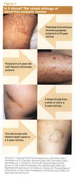 When purpura spots are very small (<1 cm in diameter), they are called petechiae or petechial haemorrhages. Bleeding And Bruising Formulating Your Response Finding The Cause Of Abnormal Bleeding And Bruising Calls For Targeted Hematologic And Family Histories A Thorough Physical Exam And Appropriate Lab Studies Document