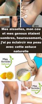 Mes Aisselles Mon Cou Et Mes Genoux Etaient Sombres Heureusement J Ai Pu Eclaircir Ma Peau Avec Cette Astuce Naturelle Self Care Health Care Hair Beauty