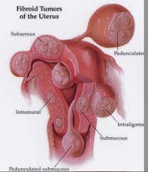If you think you might want to get pregnant in the future, your doctor might suggest a myomectomy. Myomectomy Fibroid Treatment Collaborative