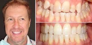 Can invisalign ruin your teeth? How Does Invisalign Work It S Awesome Utica Dental