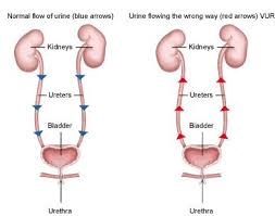 This Is What I Have Reflux Nephropathy It Shows You How It Can Ruin Your Kidneys Urine Backs Up The Pediatric Nursing Nursing Mnemonics Medical Problems