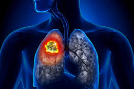 Lung cancer, also known as lung carcinoma, is a malignant lung tumor characterized by uncontrolled cell growth in tissues of the lung. Promising New Lung Cancer Treatment Combines Two Pre Existing Drugs