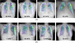 A free large database of high quality radiology cases with differential diagnoses and mnemonics to help with board. Covid 19 Detection And Heatmap Generation In Chest X Ray Images