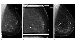 It's so important to listen to the messages our bodies are telling. 3d Mammography Significantly Reduces Breast Biopsy Rates Technology Networks