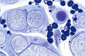 Peripheral Neuropathy Wikipedia