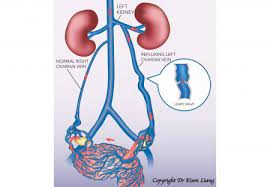 Pelvic Congestion Syndrome Treatment Resources Sydney Fibroid Clinic