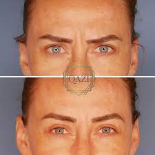 Botox injections block certain chemical signals from nerves, mostly signals that cause muscles to contract. Are You Complaining Botox Didn T Work On Me Qazi Clinic Irvine Ca