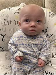 Rottweiler with Vitiligo