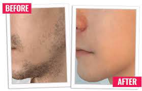 Recommend a customized treatment plan that allows you to gain maximum results. Buy Permanent Hair Removal Cream Online Hairfree