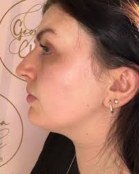 My lovely client is wedding ready!👰‍♀️ Right pic before, left pic after ❤️  We did a course of fat dissolving around her jaw and under her chin and  also did some chin