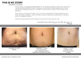 Stretch Marks Have You Covering Up Take The 60 Day Challenge And See For Yourself If You C Rodan And Fields Derma Roller Stretch Marks Coconut Oil Body Scrub