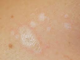 But the itching is driving me mad. The Differential Diagnosis Of Itchy Skin Dermnet Nz