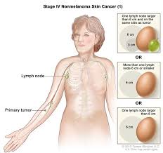I'd had a few skin cancers removed before, all basal cell carcinomas (bccs), the most common type.but when i was diagnosed with a squamous cell carcinoma (scc) on my scalp, it seemed different, and a little more scary. Cancerhelp Online Nci Cancer Diagnosis And Treatment