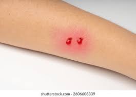 Image result for Snake Bite