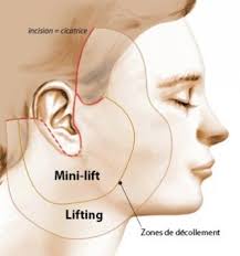 Prix du lifting du visage : Mini Lifting Du Visage Marseille Docteur Thomas Guidicelli