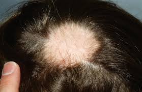 If cortisone injections are used for hair loss, dr. Alopecia Areata Causes Symptoms And Best Treatment For Alopecia Areata
