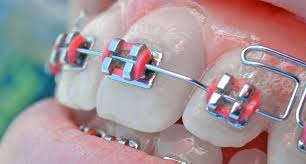 Aao Reminds Families About Changes In Fsa Rules Dental Tribune International Orthodontics Dental Braces Orthodontics Braces