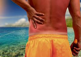 Image result for Sunburn