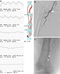 Slope unblocked game is a great running game where you can measure your reflexes. Raising The Bar For Appropriateness In The Care Of Patients With Peripheral Artery Disease Journal Of Vascular Surgery Cases And Innovative Techniques