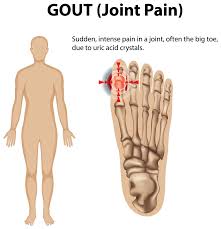 Image result for gout symptoms toe
