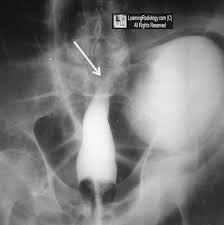 Bird Of Prey Sign Tapered Column Of Barium Sigmoid Volvulus Radiology Signs General Surgery