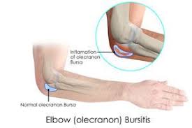 Perform stretches/ mobility exercises for 5x30 seconds. Elbow Bursitis Treatment Las Vegas Olecranon Bursitis Henderson
