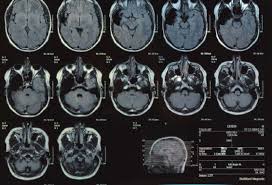 Ct scans greatly improve diagnostic capabilities (which improve clinical outcomes) but they deliver higher radiation doses than other tests. Scans For Diagnosis The Brain Tumour Charity