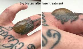 Also with 2 handpieces or 3 handpieces. Laser Tattoo Removal Aftercare Blisters 11 Proven Solutions 2019 Vivalaser