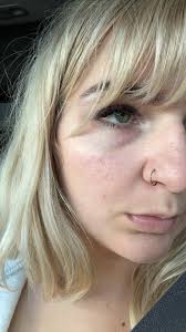 Sebaceous Filaments or Congested Pores?