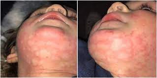 What foods most often cause food allergy? Food Allergy Rash Pictures Mum Warns About Anaphylactic Reaction