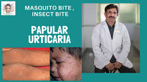 Image result for Papular urticaria
