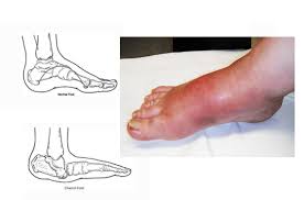 5 ds or 6 ds (separating disorganization and dislocation) . Charcot Foot Best Diabetes Hospital In Kerala