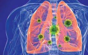 Publicat pe 25 iulie 2020. Cum TratÄm Corect Pneumonia
