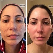 ‫معجزه مزونیدلینگ برای لک صورت + عکس قبل و بعد - متخصص پوست و مو دکتر  محرابیان‬‎