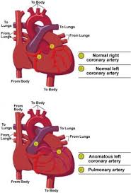 Veins bring blood to the heart to pump back out again on arteries. Anomalous Left Coronary Artery Cs Mott Children S Hospital Michigan Medicine