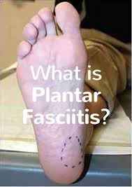 Pin On Plantar Fasciitis Treatment Exercises Symptoms And Causes