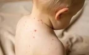 ما هو الجدرى المائي - الاعراض والاسباب والعلاج - مجموعة درياق الطبية - الرئيسية