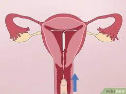 See risk info & boxed warning. How To Check Mirena Strings 8 Steps With Pictures Wikihow