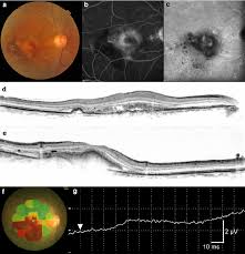 Macular Function In An Eye With Neovascular Age Related