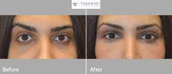 Laser eye surgery has become the most popular way to correct eyesight in the uk, aside from wearing glasses and contact lenses. Infraorbital Rim Implant Photos Mehryar Ray Taban Md