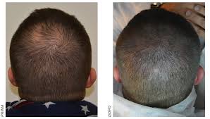 La tricopigmentazione (micropigmentazione del cuoio capelluto/smp) è un trattamento . Tricopigmentazione Belfattolab Roma Milano Napoli Latina Vicenza