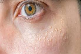 Goz Etrafindaki Yag Bezeleri Neden Olur Yag Bezeleri Nasil Gecer Pimples Blackheads Skin Care